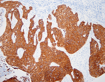 Cytokeratin 6 CK6