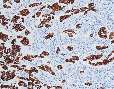 Cytokeratin 7 CK7