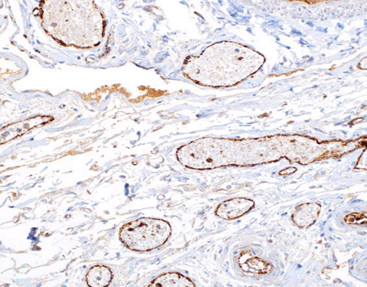 Factor VIII-Ralated Antigen (Human von Willebrand Factor )