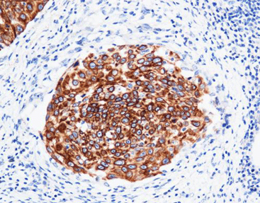 Cytokeratin 5 CK5