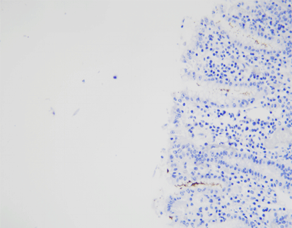 Helicobacter Pylori (HP）