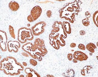 Prostate Specific Acid Phosphatase (PSAP)