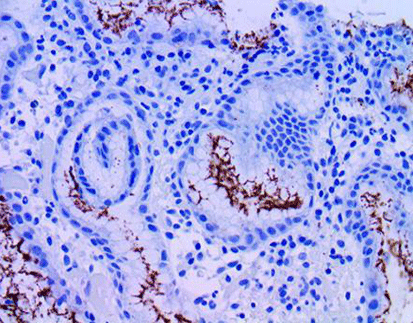 Helicobacter Pylori