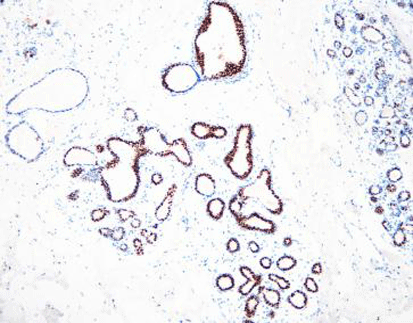 Progesterone Receptor