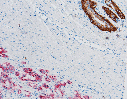 34βE12/P63/AMACR Detection Kit (Immunocytochemistry)