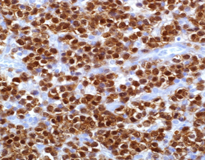 T-cell leukemia/lymphoma  protein 1（TCL1）