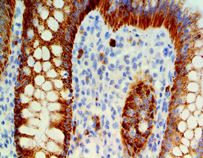 Insulin -like growth factor II mRNA binding proterin 3(IMP3)