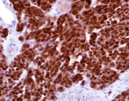 Microphthalmia Transcription Factor (MiTF)