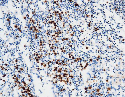 Multiple Myeloma Oncogene 1 (MUM-1)