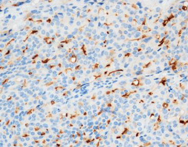 Prostate Specific Membrane Antigen (PSMA)