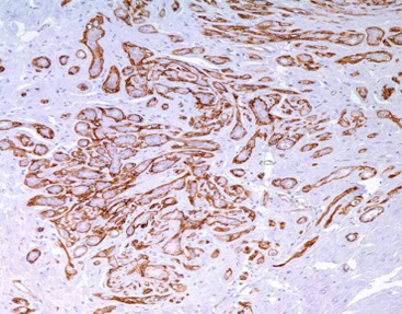 Nerve Growth Factor Receptor (NGFR)