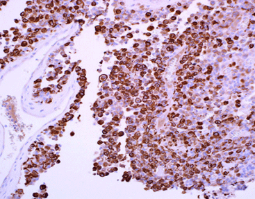 Neurofilament Antibodies (NF)