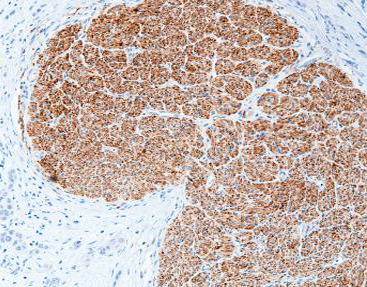 Neuron Specific Enolase (NSE)
