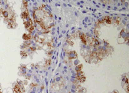Use of IHC Markers to Distinguish Endometrial Clear Cell Carcinoma From Its Morphologic Mimics