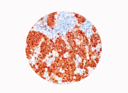 p16/Ki-67 Dual-staining Cytology in Cervical Cancers