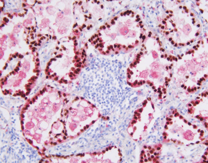 TTF-1/Napsin A detection reagent (Immunohistochemical)