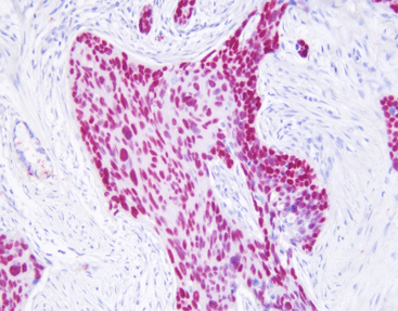 Napsin A/p40 detection reagent (Immunohistochemical)