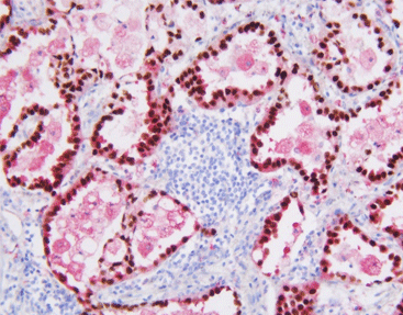 TTF-1/Napsin A detection reagent (Immunohistochemical)