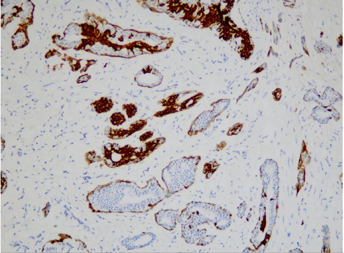 Fast Frozen IHC Ck5/6 in the Differentiation Diagnosis
