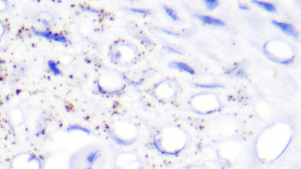HPV E6/E7: A Key Biomarker in Cancer Diagnosis